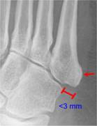 Lisfranc with arrows-5