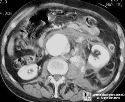 ruptured  kidney