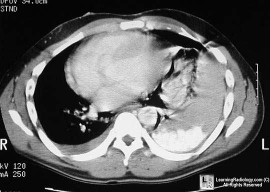 Boerhaave Syndrome