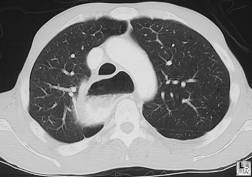 achalasia