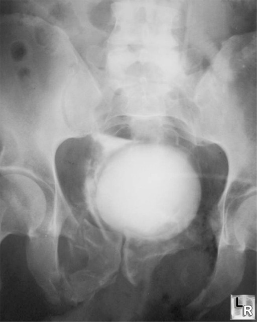 bladder rupture