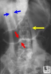 falciform ligament sign