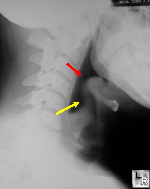 There is also reversal of the normal lordotic curve in the cervical spine 