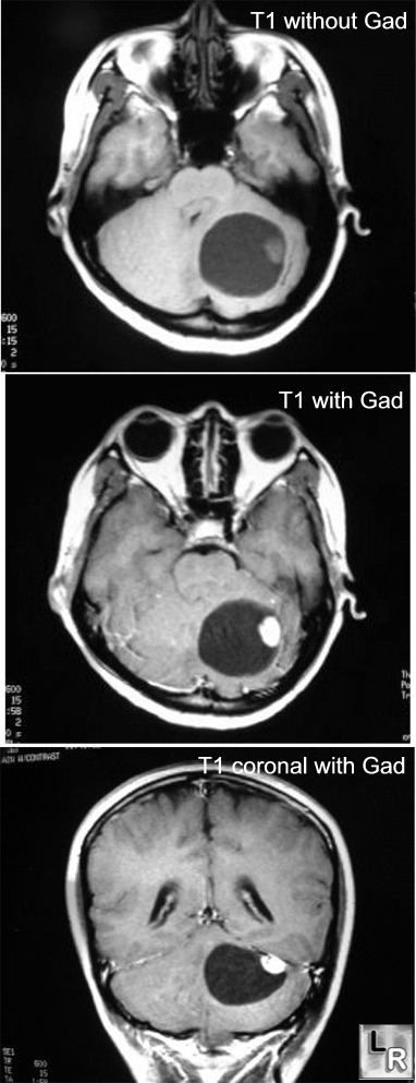 cerebellar hemangioblastoma