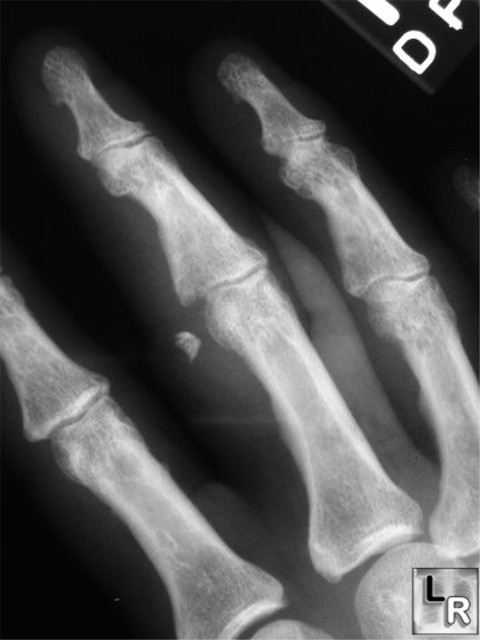 volar plate fracture