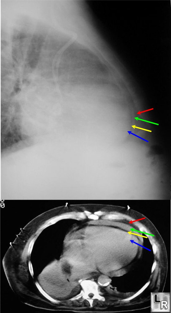 pericardial effusion