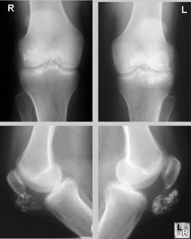 prepatellar bursitis