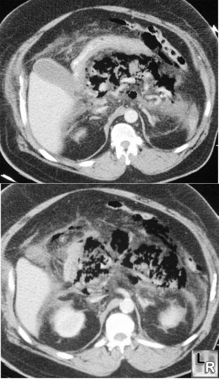 Emphysematous Pancreatitis