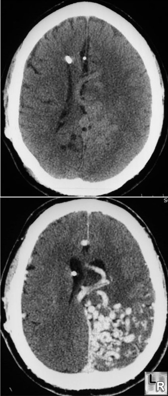 cerebral avm