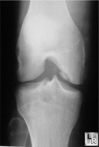 osteochondritis dissecans