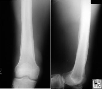 hypertrophic osteoarthropathy, hoa