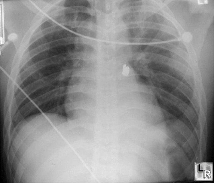 Left pneumothorax-deep sulcus sign