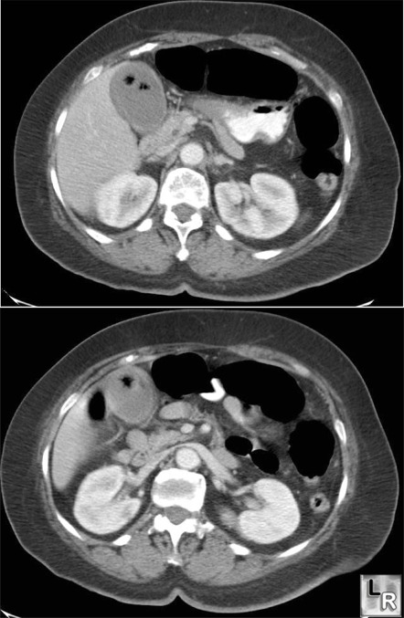 gas in gallstone