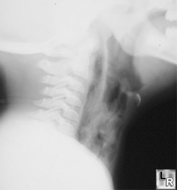 perforated pharynx