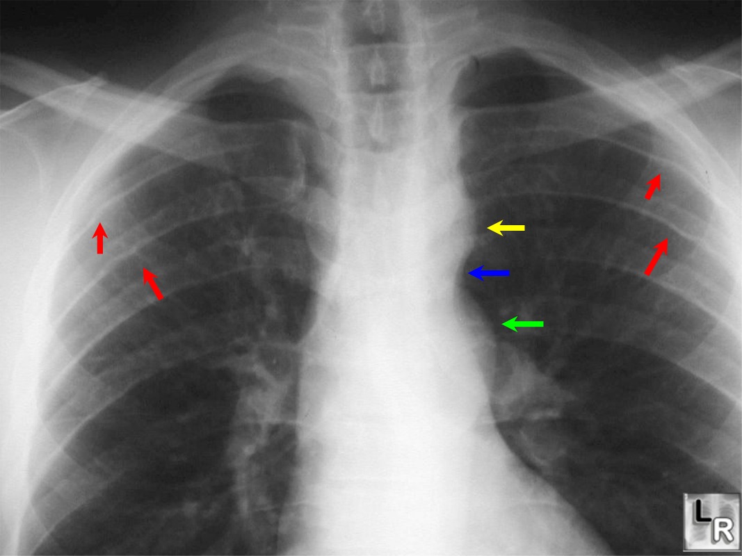 Learning Radiology Coarctation Of Aorta