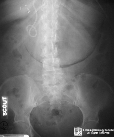 gastric emphysema