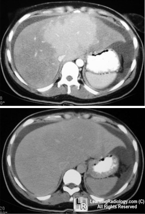 budd-chiari syndrome