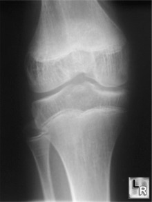 hemophiliac arthritis