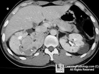 angiomyolipoma