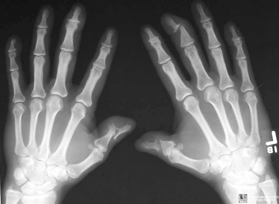 psoriatic arthritis, hands