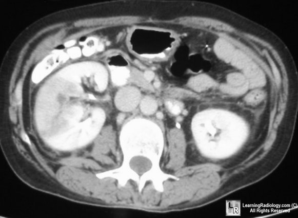 acute pyleonephritis