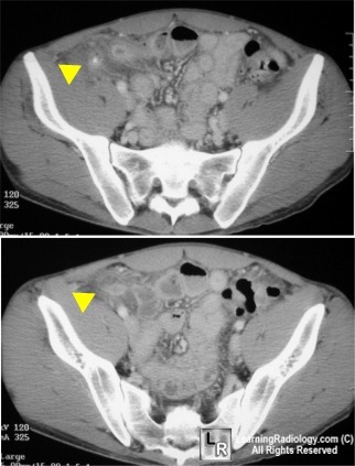 acute appendicitis