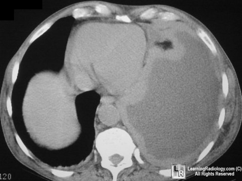 http://www.learningradiology.com/caseofweek/caseoftheweekpix/cow64.jpg