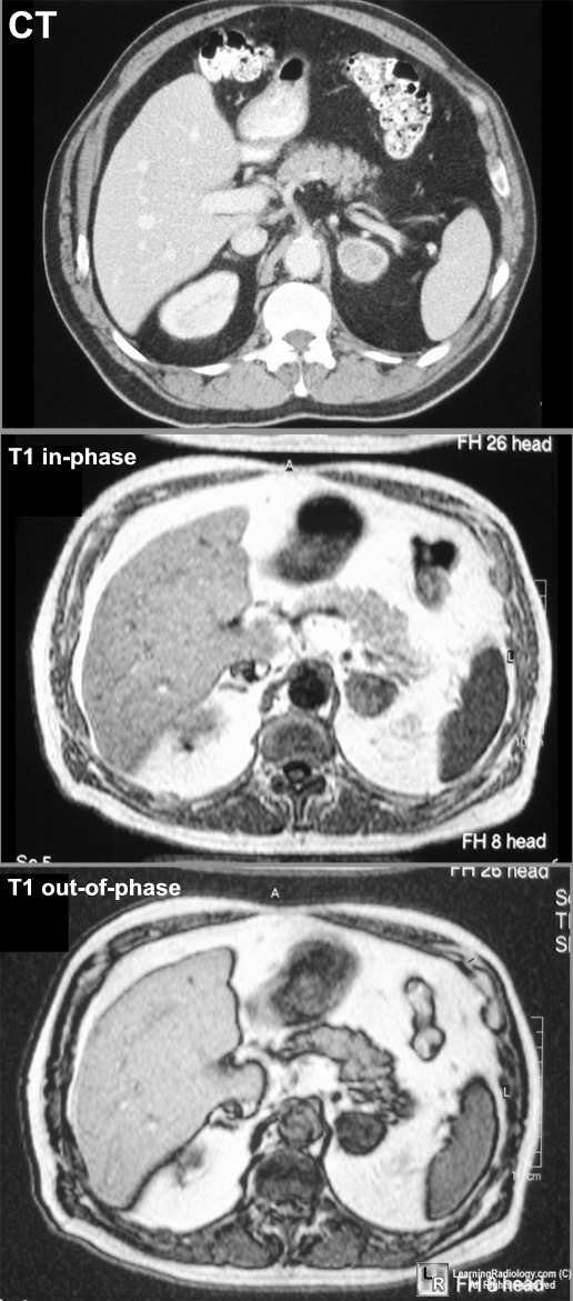 adrenal adenoma