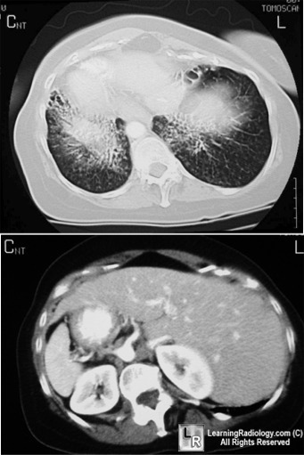 kartegener syndrome