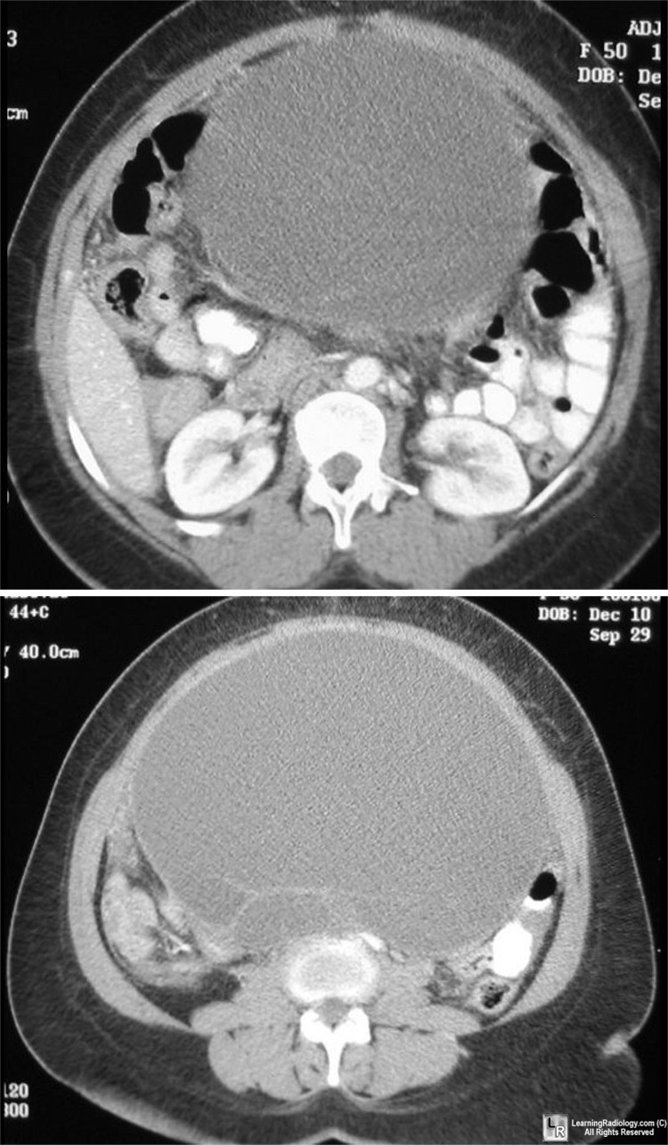 serous cystadenoma ovary