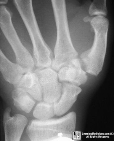 Fracture+displacement