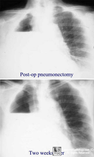 broncho-pleural fistula