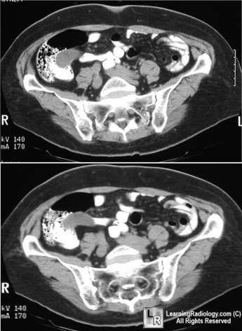 Mucocele of the appendix