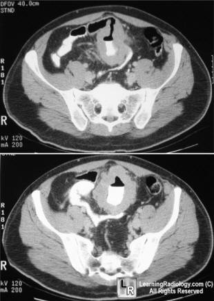 small bowel lymphoma