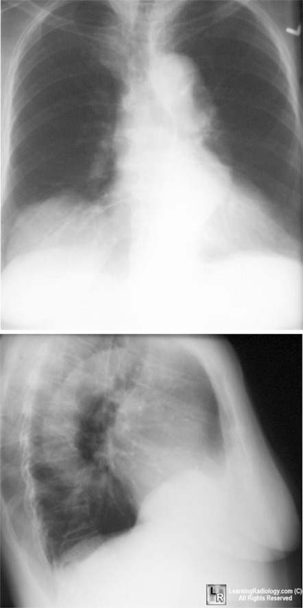 Eventration of the Diaphragm