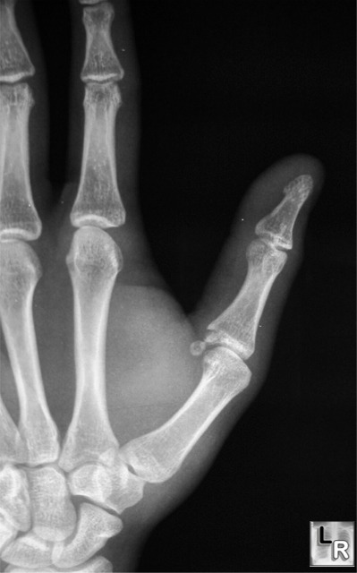 LearningRadiology - Gamekeeper's Thumb, Skier's Thumb, Break-Dancer's Thumb