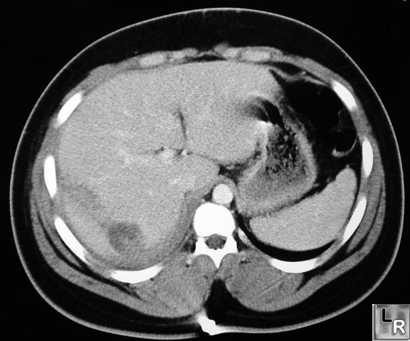 hepatic rupture