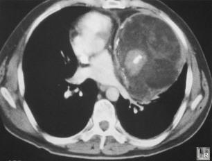 Mediastinal Teratoma