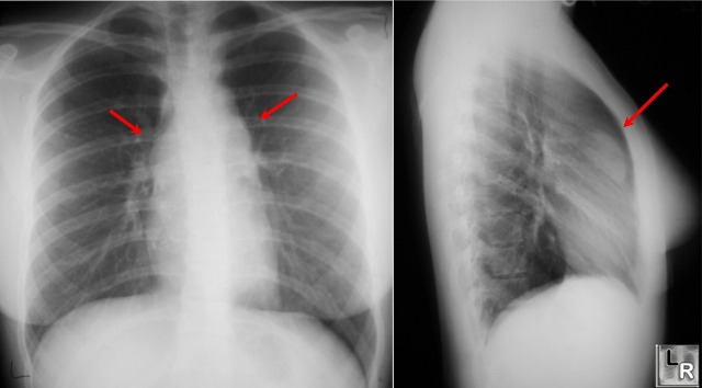 Learningradiology Hodgkin Disease Lymphoma