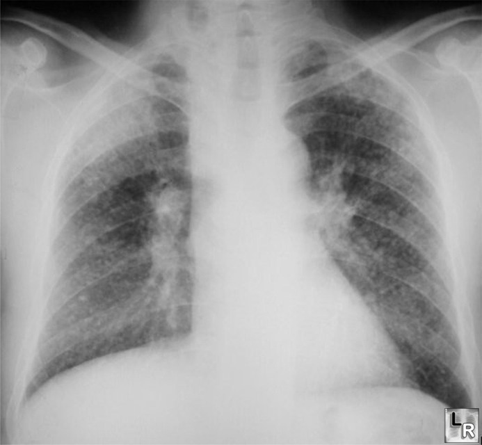 apical fibrosis