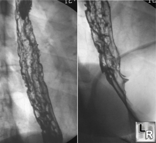 candida esophagitis