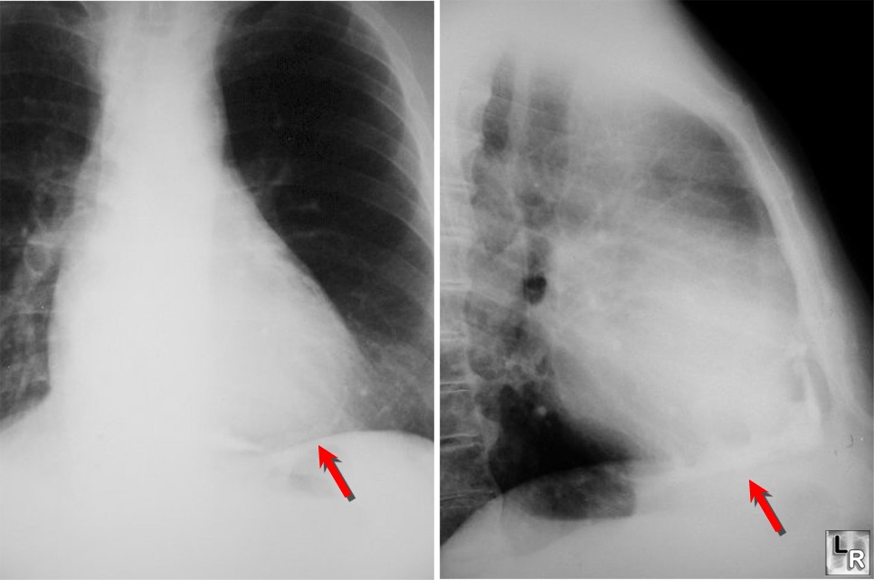 Constrictive Pericarditis