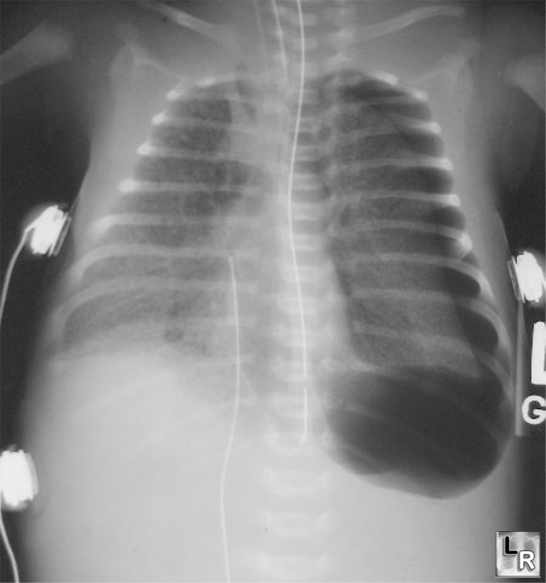 Learningradiology Respiratory Distress Syndrome Of The Newborn