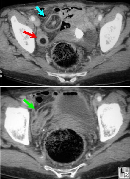 Intussusception