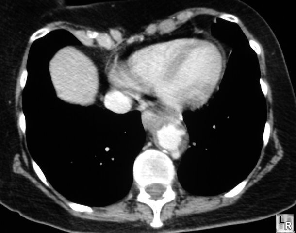 Penetrating Aortic Ulcer