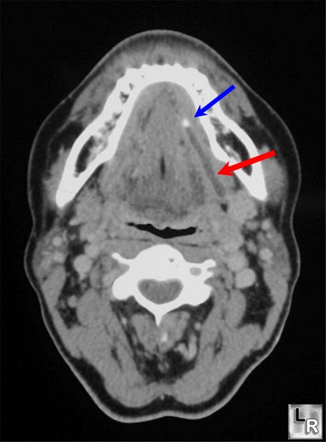 Learning Radiology - Sialolithiasis, Stone in Wharton's Duct