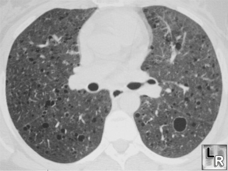 LAM ,lymphangiomyomatosis