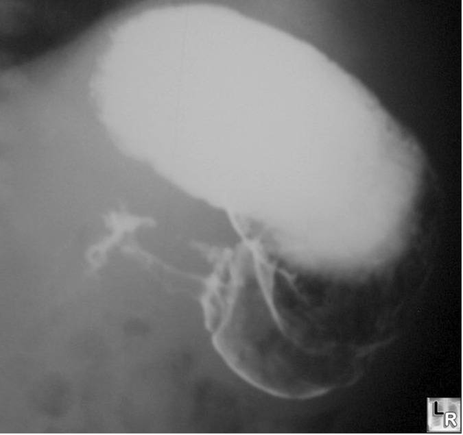 Hypertrophic Pyloric Stenosis