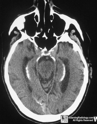 Fahr Disease