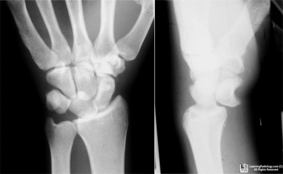 Lunate Dislocation